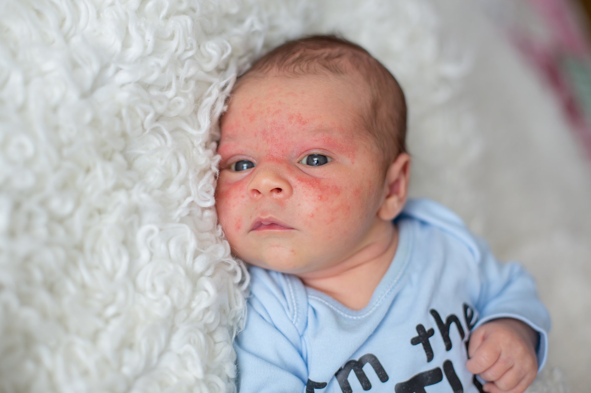 media Uitstroom Advertentie Eczeem bij je baby: alles over deze huidaandoening