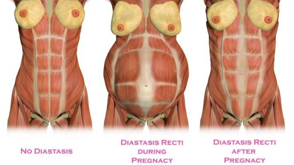 helling Mededogen Steen Diastase tijdens en na de zwangerschap